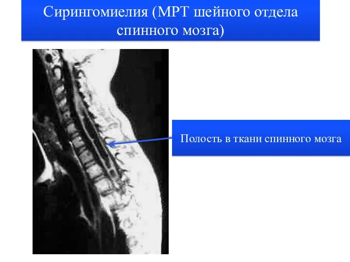 Сирингомиелия (МРТ шейного отдела спинного мозга) Полость в ткани спинного мозга