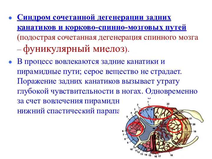 Синдром сочетанной дегенерации задних канатиков и корково-спинно-мозговых путей (подострая сочетанная дегенерация