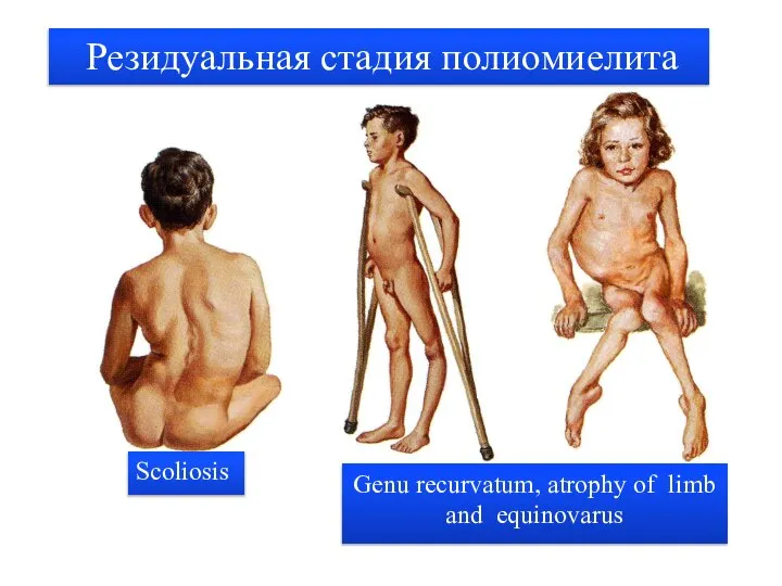 Резидуальная стадия полиомиелита Scoliosis Genu recurvatum, atrophy of limb and equinovarus