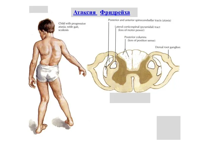 Атаксия Фридрейха