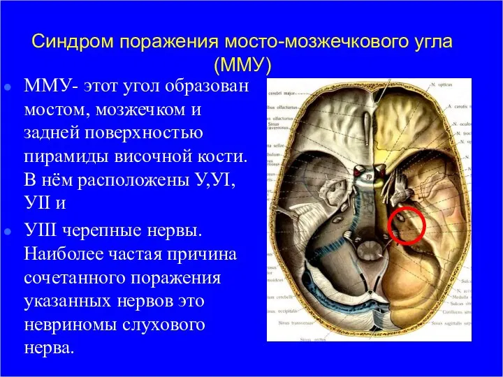 Синдром поражения мосто-мозжечкового угла (ММУ) ММУ- этот угол образован мостом, мозжечком