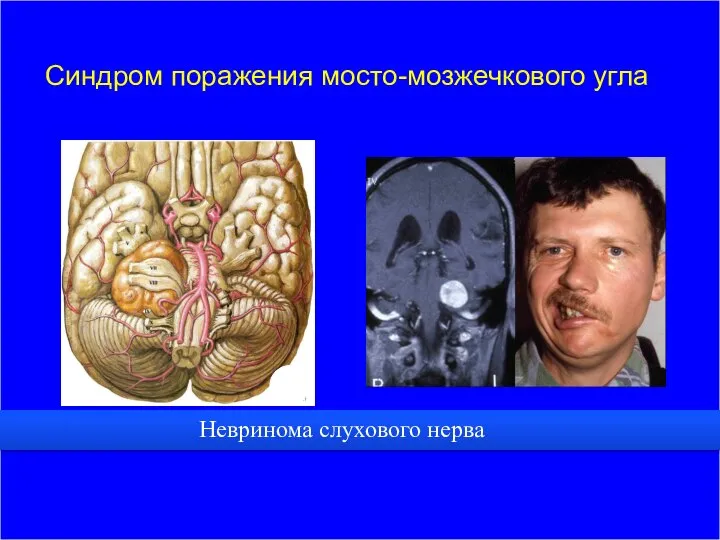 Синдром поражения мосто-мозжечкового угла Невринома слухового нерва