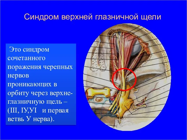 Синдром верхней глазничной щели Это синдром сочетанного поражения черепных нервов проникающих