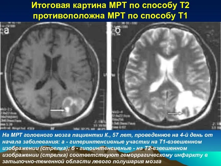 Итоговая картина МРТ по способу Т2 противоположна МРТ по способу T1