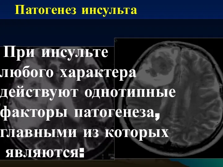 При инсульте любого характера действуют однотипные факторы патогенеза, главными из которых являются: Патогенез инсульта