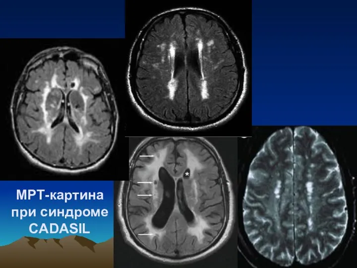 МРТ-картина при синдроме CADASIL
