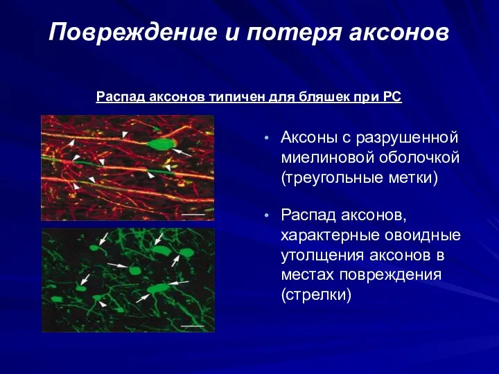 Повреждение и потеря аксонов Аксоны с разрушенной миелиновой оболочкой (треугольные метки)