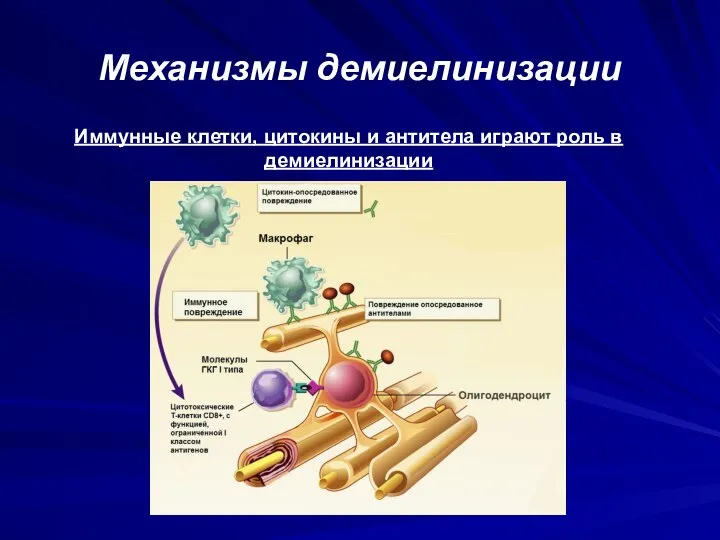 Механизмы демиелинизации Иммунные клетки, цитокины и антитела играют роль в демиелинизации
