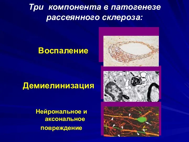 Демиелинизация Нейрональное и аксональное повреждение Воспаление Три компонента в патогенезе рассеянного склероза: .