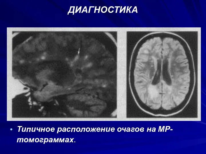 ДИАГНОСТИКА Типичное расположение очагов на МР-томограммах.