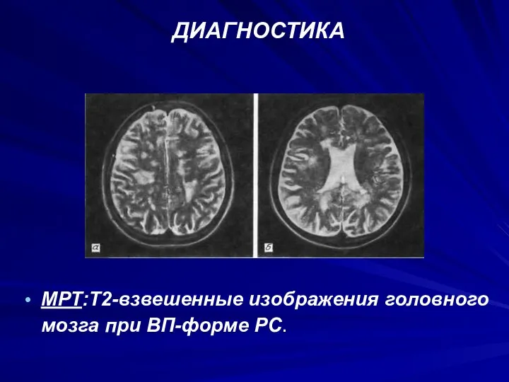 ДИАГНОСТИКА МРТ:Т2-взвешенные изображения головного мозга при ВП-форме PC.