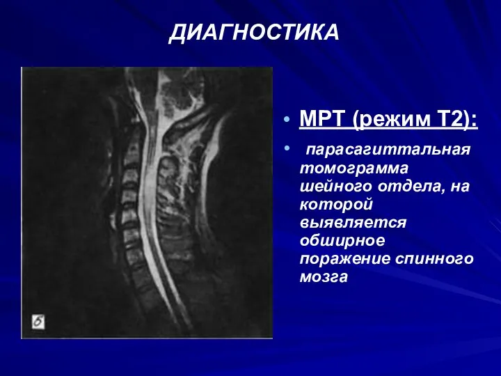 ДИАГНОСТИКА МРТ (режим Т2): парасагиттальная томограмма шейного отдела, на которой выявляется обширное поражение спинного мозга