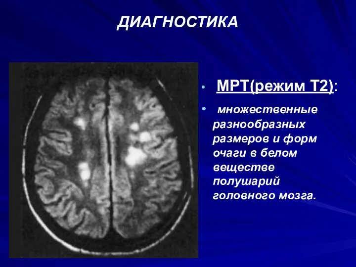 ДИАГНОСТИКА МРТ(режим Т2): множественные разнообразных размеров и форм очаги в белом веществе полушарий головного мозга.