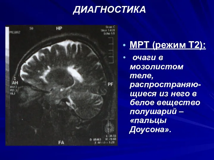 ДИАГНОСТИКА МРТ (режим Т2): очаги в мозолистом теле, распространяю-щиеся из него
