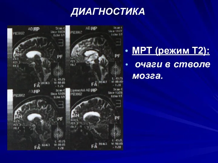 ДИАГНОСТИКА МРТ (режим Т2): очаги в стволе мозга.