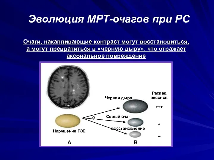 Эволюция МРТ-очагов при РС . Очаги, накапливающие контраст могут восстановиться, а