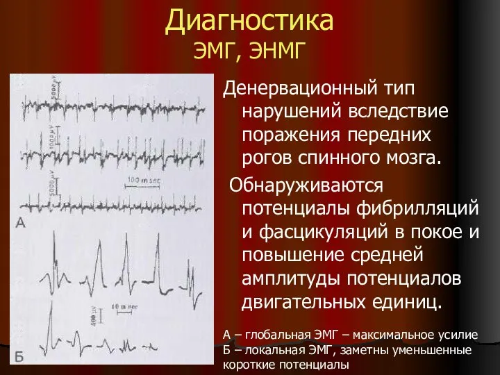 Диагностика ЭМГ, ЭНМГ Денервационный тип нарушений вследствие поражения передних рогов спинного