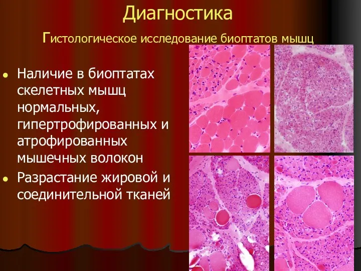 Диагностика гистологическое исследование биоптатов мышц Наличие в биоптатах скелетных мышц нормальных,