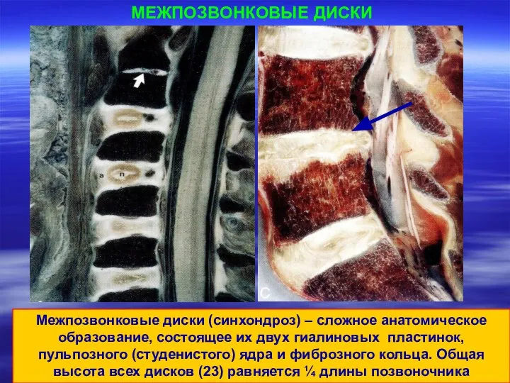 МЕЖПОЗВОНКОВЫЕ ДИСКИ Межпозвонковые диски (синхондроз) – сложное анатомическое образование, состоящее их