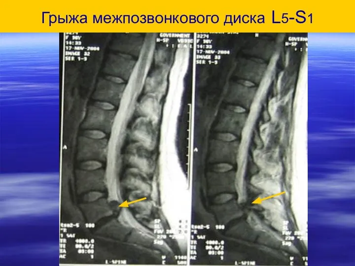 Грыжа межпозвонкового диска L5-S1