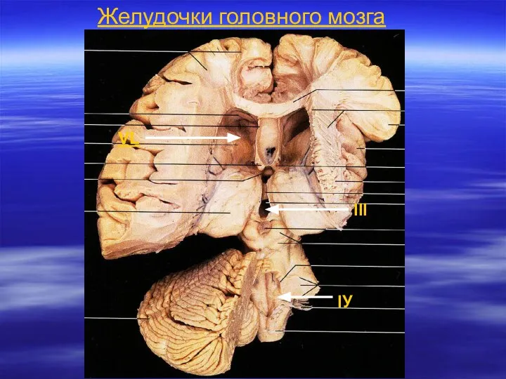 Желудочки головного мозга VL III IУ