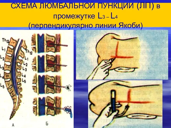 СХЕМА ЛЮМБАЛЬНОЙ ПУНКЦИИ (ЛП) в промежутке L3 – L4 (перпендикулярно линии Якоби)