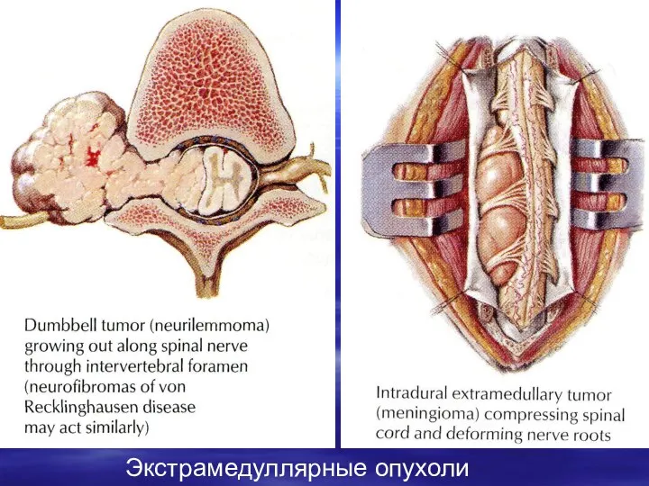 Экстрамедуллярные опухоли