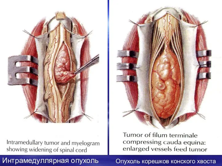 Интрамедуллярная опухоль Опухоль корешков конского хвоста
