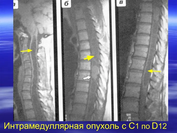 Интрамедуллярная опухоль с С1 по D12