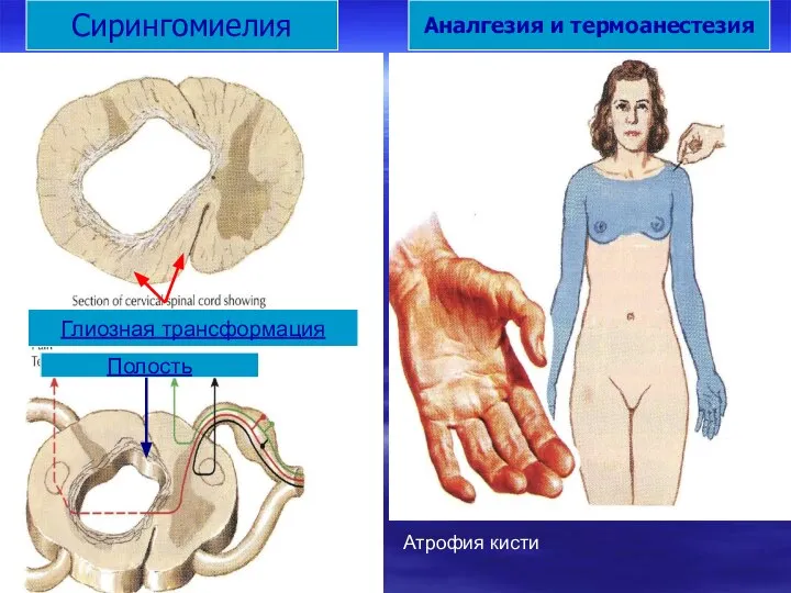 Сирингомиелия Аналгезия и термоанестезия Полость Глиозная трансформация Атрофия кисти