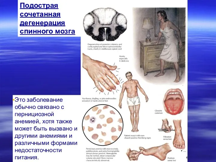 Это заболевание обычно связано с пернициозной анемией, хотя также может быть