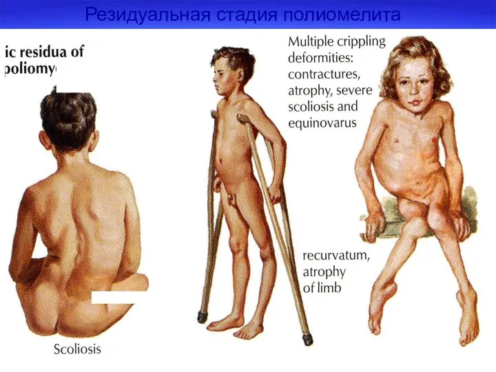 Резидуальная стадия полиомелита