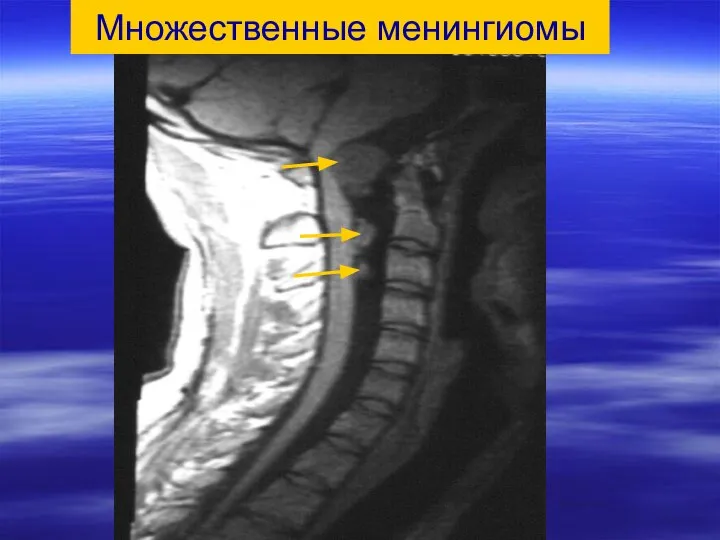 Множественные менингиомы