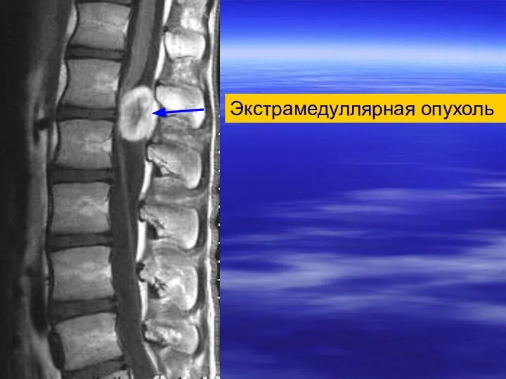 Экстрамедуллярная опухоль