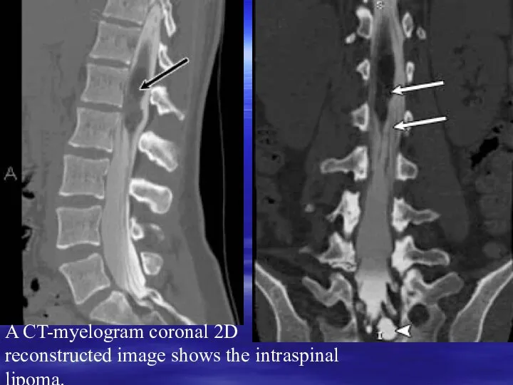 A CT-myelogram coronal 2D reconstructed image shows the intraspinal lipoma.