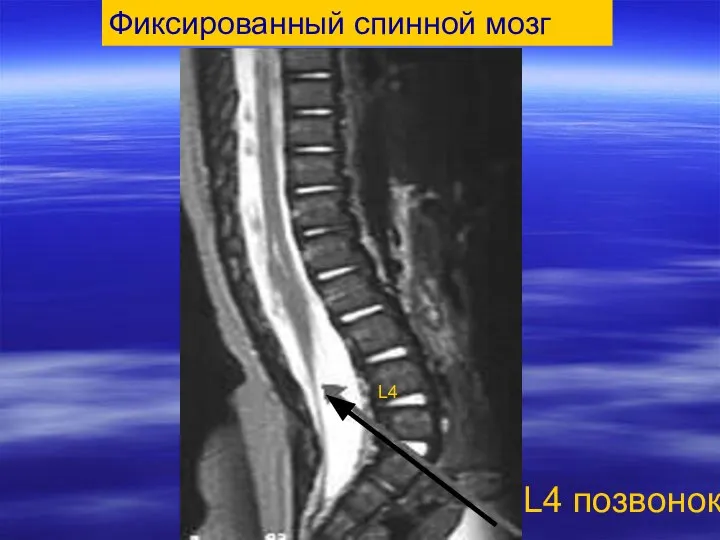 Фиксированный спинной мозг L4 позвонок L4