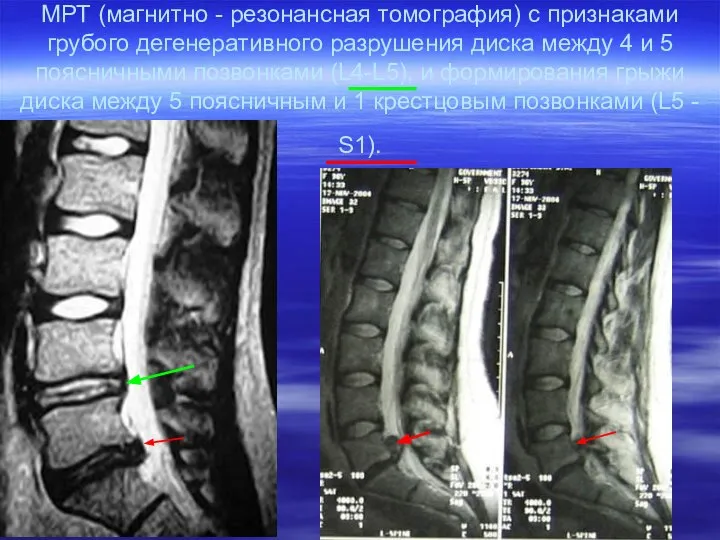 МРТ (магнитно - резонансная томография) с признаками грубого дегенеративного разрушения диска