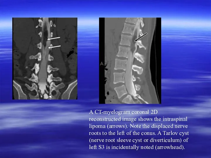 A CT-myelogram coronal 2D reconstructed image shows the intraspinal lipoma (arrows).