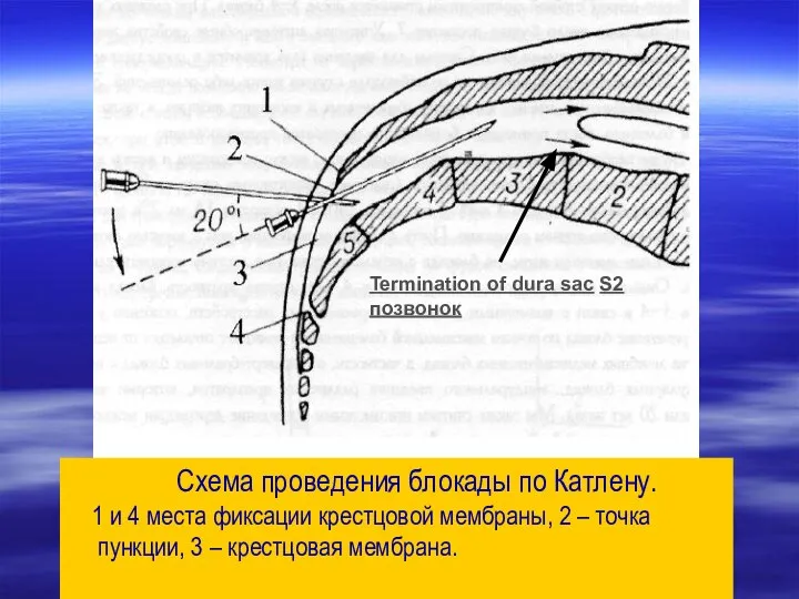 Схема проведения блокады по Катлену. 1 и 4 места фиксации крестцовой