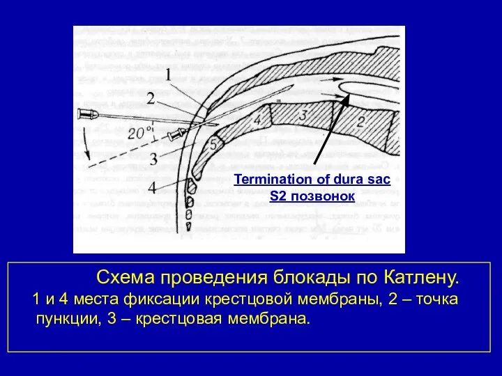 Схема проведения блокады по Катлену. 1 и 4 места фиксации крестцовой