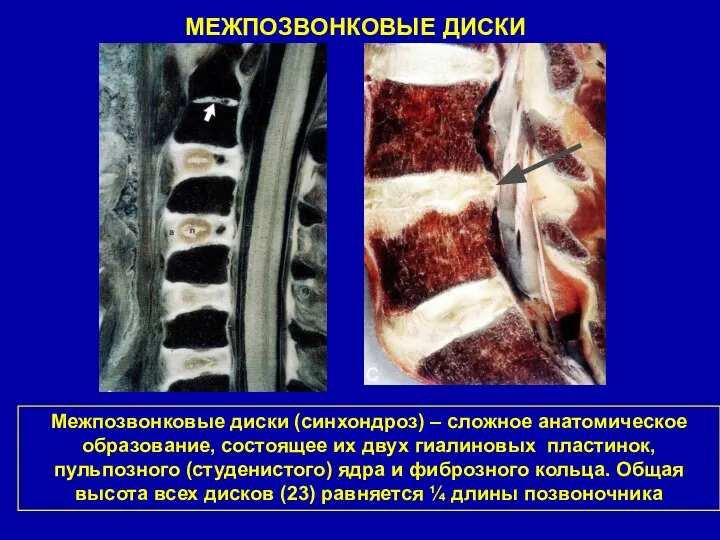 МЕЖПОЗВОНКОВЫЕ ДИСКИ Межпозвонковые диски (синхондроз) – сложное анатомическое образование, состоящее их