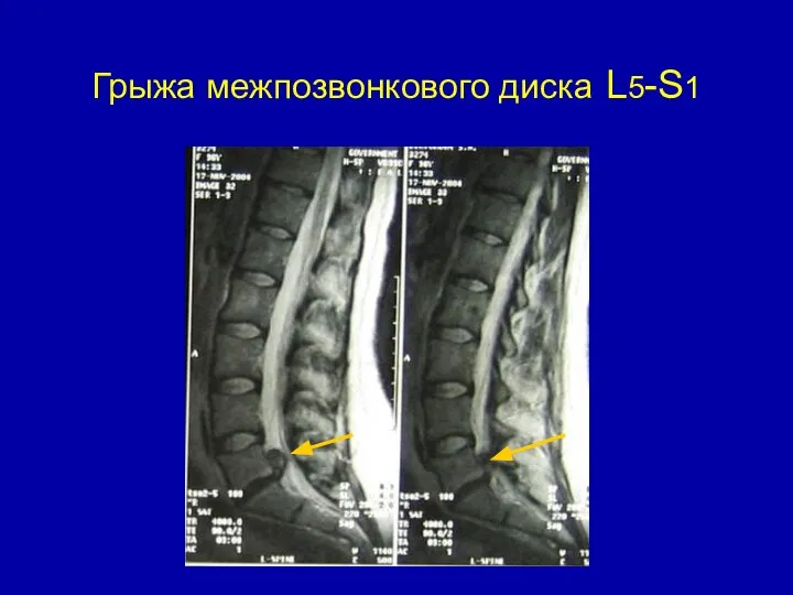 Грыжа межпозвонкового диска L5-S1