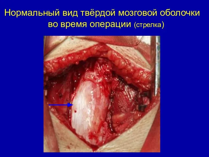 Нормальный вид твёрдой мозговой оболочки во время операции (стрелка)
