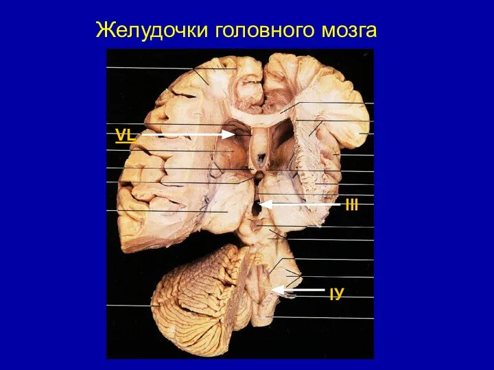 Желудочки головного мозга VL III IУ