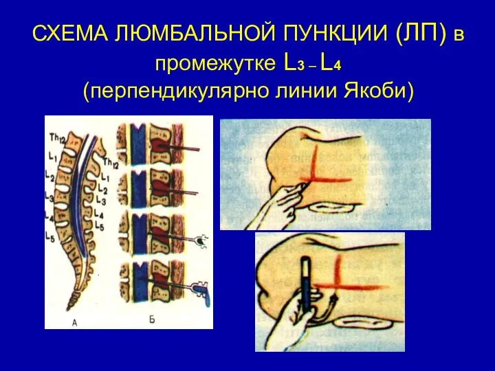 СХЕМА ЛЮМБАЛЬНОЙ ПУНКЦИИ (ЛП) в промежутке L3 – L4 (перпендикулярно линии Якоби)