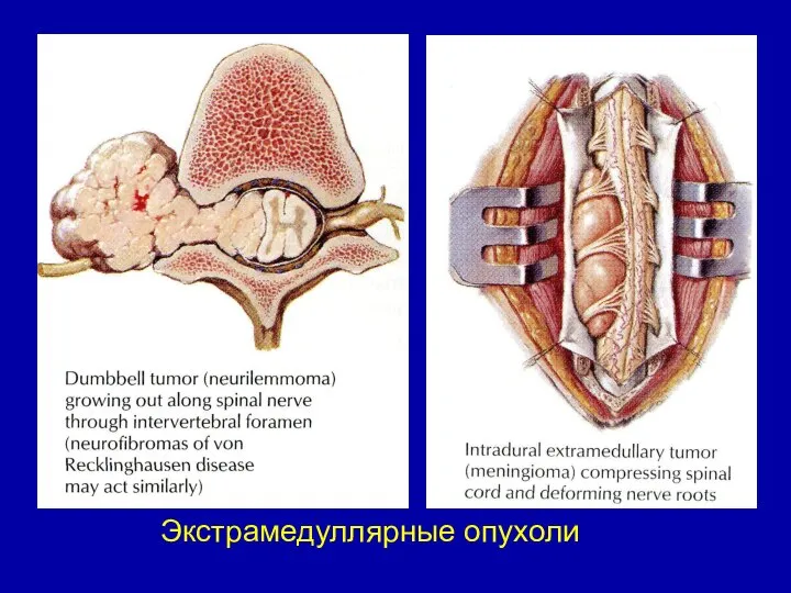 Экстрамедуллярные опухоли