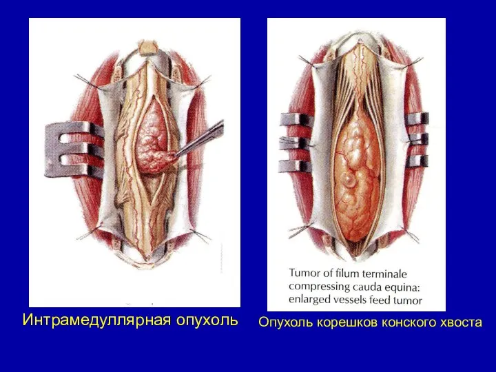 Интрамедуллярная опухоль Опухоль корешков конского хвоста