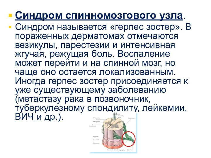 Синдром спинномозгового узла. Синдром называется «герпес зостер». В пораженных дерматомах отмечаются