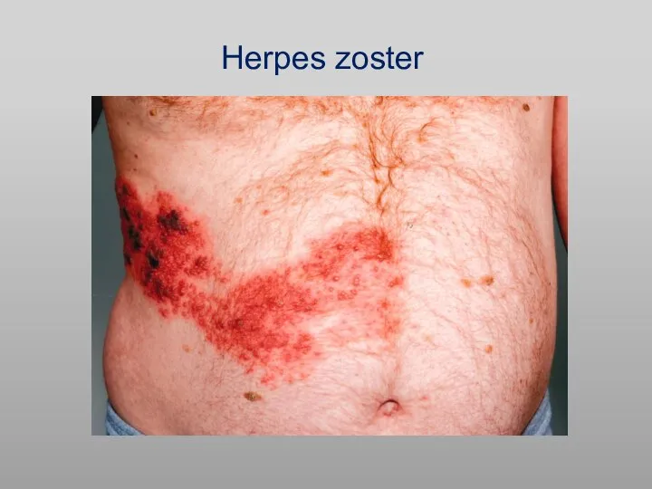 Herpes zoster