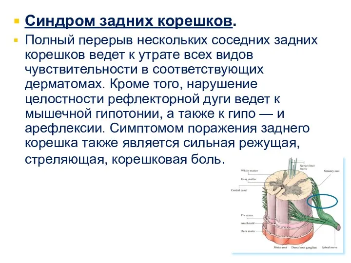 Синдром задних корешков. Полный перерыв нескольких соседних задних корешков ведет к